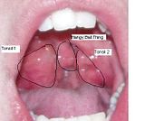 Tonsils.jpg image by cornelius113
